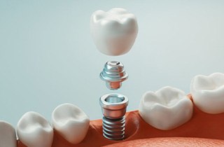 Digital image of the three parts of an implant crown