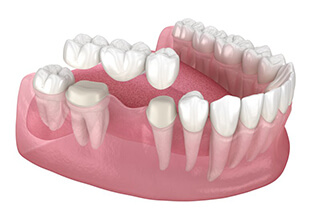 a 3D illustration of a traditional dental bridge