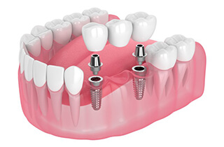 a 3D illustration of an implant dental bridge