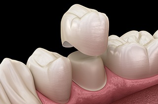 Illustration of a dental crown levitating over shaved tooth with black background