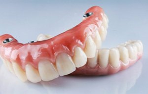 an example of implant dentures