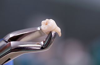 Closeup of forceps holding an extracted tooth