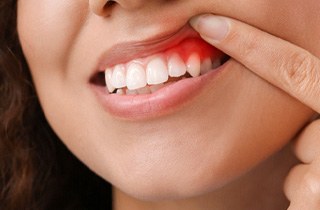 A woman revealing her red and inflamed gums