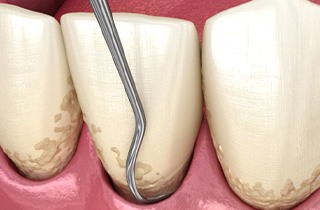 A 3D illustration of scaling and root planing treatment