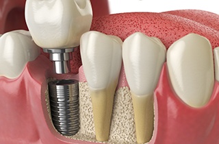 A 3D illustration of a dental implant set in a patient’s jaw 