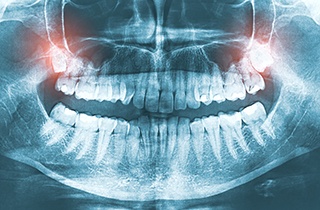 Wisdom teeth are extra molars in Dallas, TX