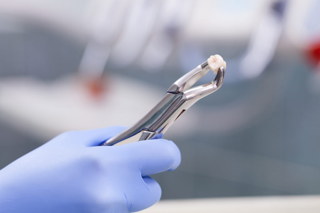 Dental instrument holding an extracted tooth - Bear Creek Family Dentistry