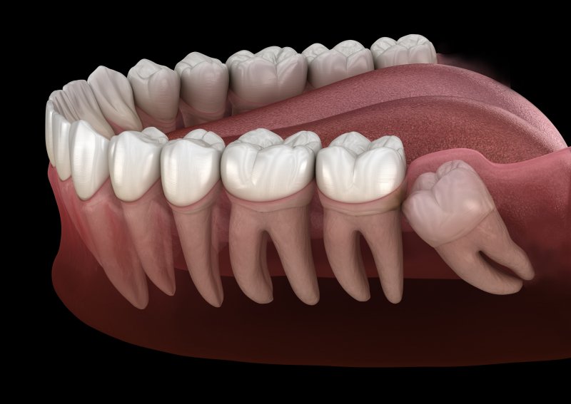 Tooth Extraction In Mesquite Wisdom Tooth Removal Risks Bear Creek