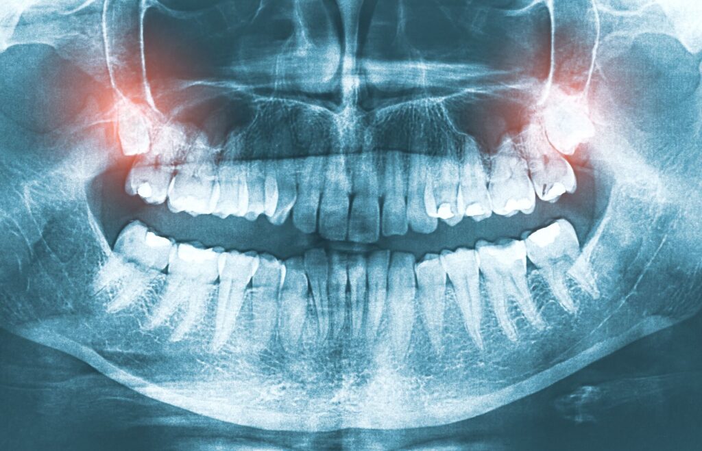 X-ray image showing wisdom teeth growing in red