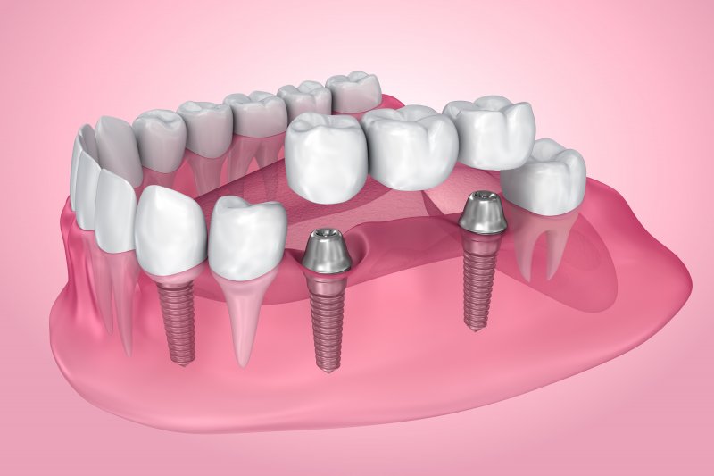 Illustration of gums with dental implants